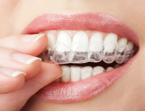 Why Wearing Your Retainer is Crucial