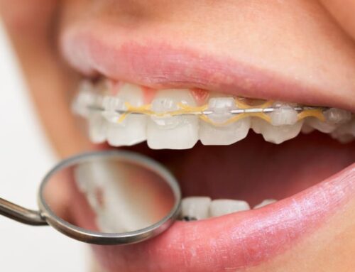 Tips for Preventing Teeth Stain With Braces